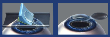 Lasik Procedure Steps 34